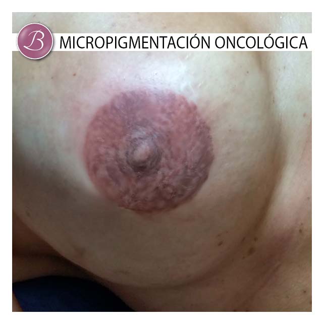 micropigmentacion oncologica