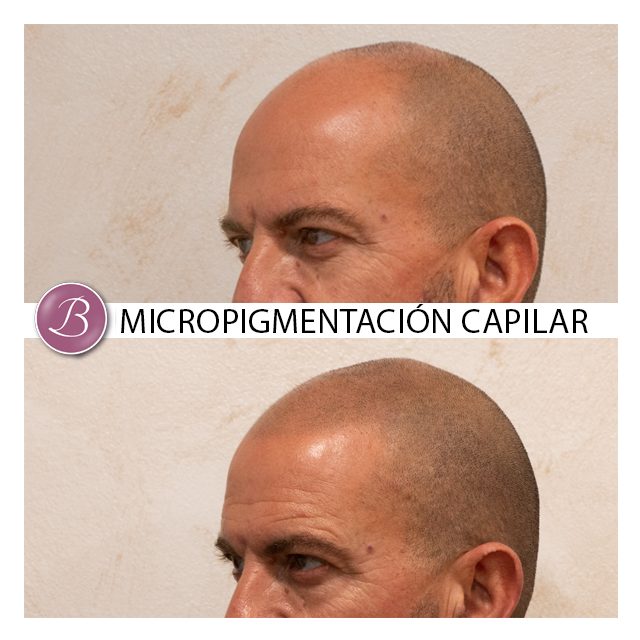 Micropigmentacon capilar zaragoza madrid 1 copia