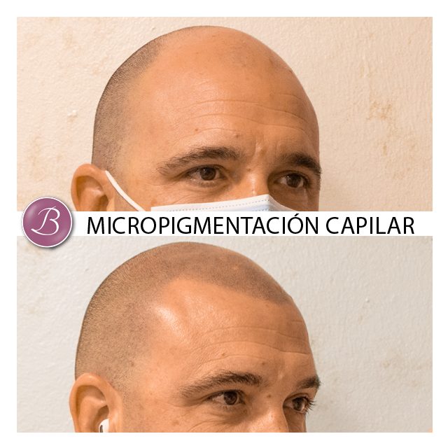 Micropigmentacion capilar zaragoza y madrid 70