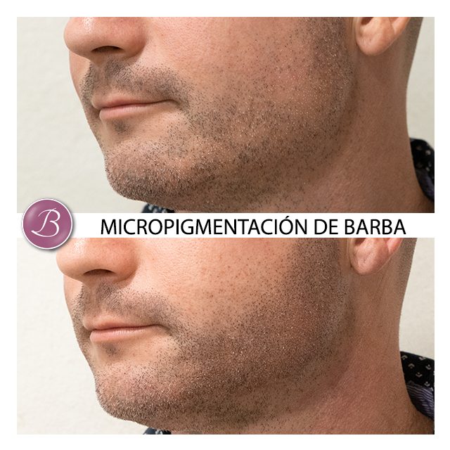 Micropigmentación de barba zaragoza madrid 23