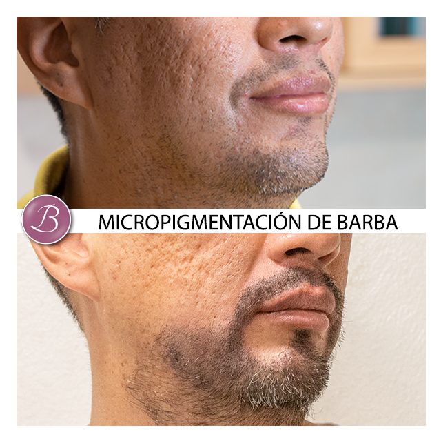 Micropigmentación de barba zaragoza madrid 12