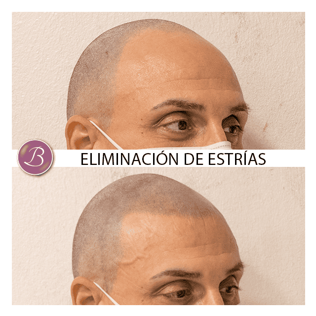 Micropigmentación capilar