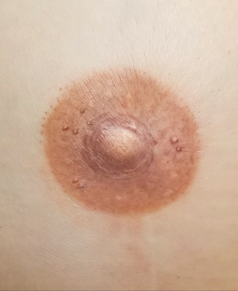 micropigmentación pezón zaragoza